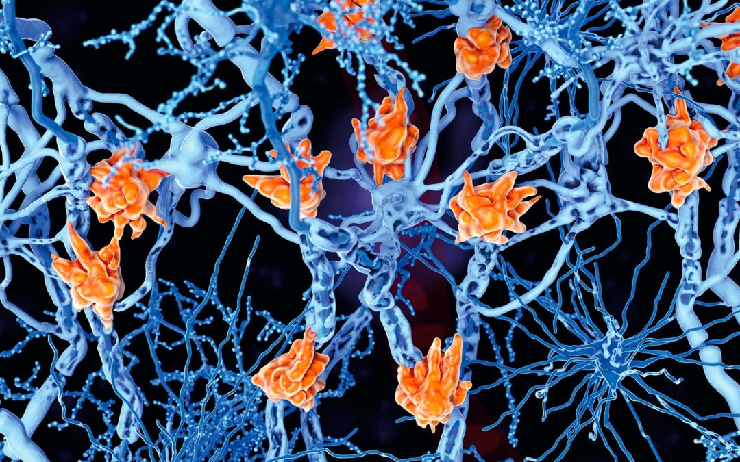 Comenzar el tratamiento ante los primeros síntomas de la esclerosis múltiple podría frenar su progresión